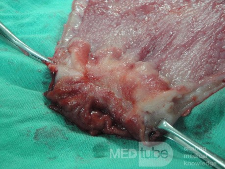 Gastric Ulcerated Adenocarcinoma of the Pre-pyloric Antrum (28 of 28)