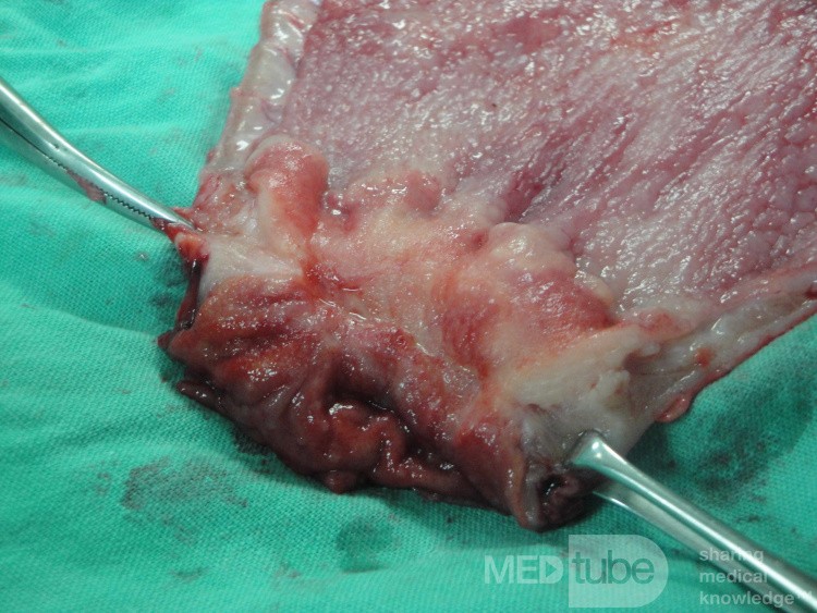 Gastric Ulcerated Adenocarcinoma of the Pre-pyloric Antrum (28 of 28)