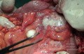 Metastasis of Renal Carcinoma to the ascending colon (8 of 11)