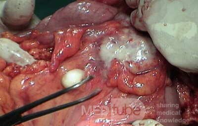 Metastasis of Renal Carcinoma to the ascending colon (8 of 11)