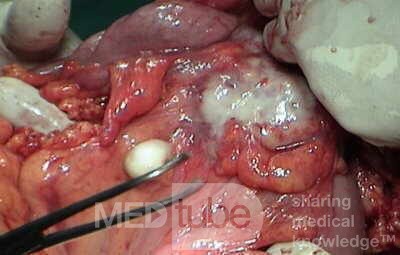 Metastasis of Renal Carcinoma to the ascending colon (8 of 11)