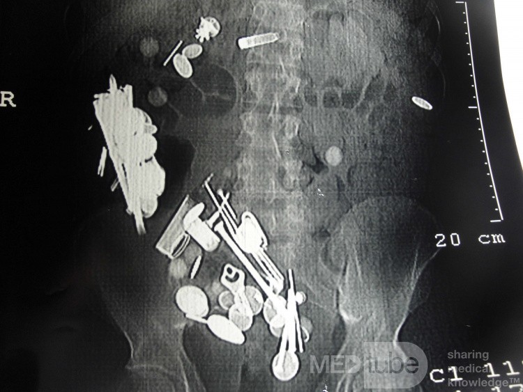 Multiple Foreign bodies in the GI tract (4 of 12)