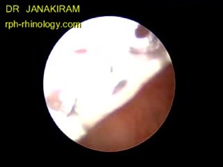 Chicken Bone In The Esophagus