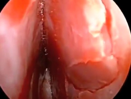 Septoplasty by Using The Septal Stapler