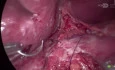 Laparoscopic Cellan-Jones Repair for Perforated Peptic Ulcer