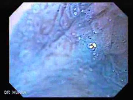 Gastric Heterotopia (inlet pach) - chromoendoscopy using methylene blue (4 of 4)