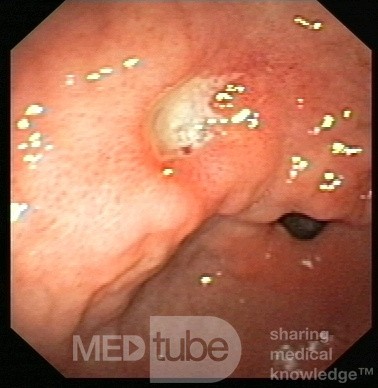 Gastric Cardia Ulcer