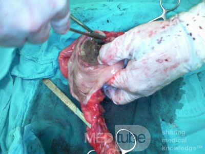 Non-Hodgkin's Lymphoma of the Colon (8 of 16)