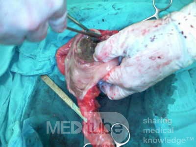 Non-Hodgkin's Lymphoma of the Colon (8 of 16)