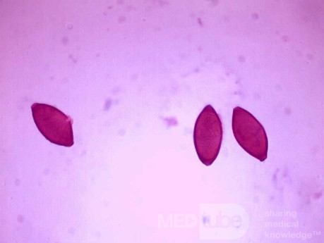 Colonoscopy observing a trichuris in the cecum (4 of 8)
