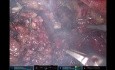 Achilles Heel of Lateral Pelvic Lymph Node Dissection