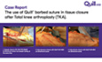 Case Report The use of Quill® Barbed Suture in Tissue Closure After Total Knee Arthroplasty (TKA)