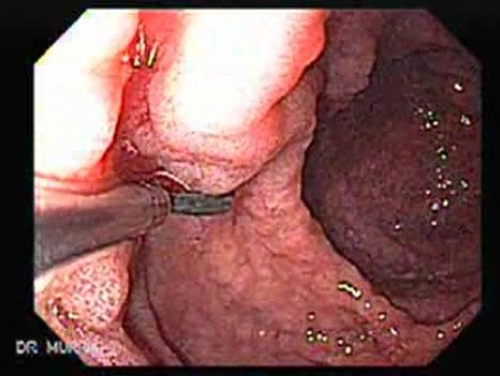 Gastric Cancer - Endoscopy (6 of 15)