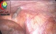 Portless Insertion of Laparoscopic Instrument