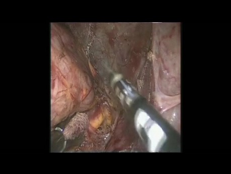 Right Adrenal Pheochromocytoma