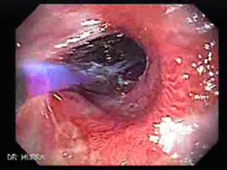 Endoscopic Baloon Dilation Of The Esophageal Stricture - Position Of The Inflated Baloon - 5/8