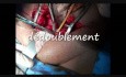 Treatment of Vesico-vaginal Fistula Post Hysterectomy by Transvesical Way