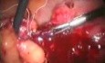 Laparoscopic Treatment Of Bowel Injury By IUD (Intrauterine Device)