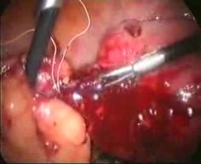 Laparoscopic Treatment Of Bowel Injury By IUD (Intrauterine Device)