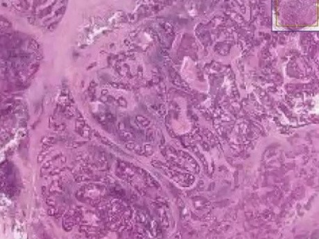 Lymph node - Adenocarcinoma
