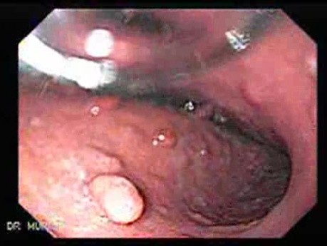 Gastric Polyposis - Endoscopy (2 of 11)