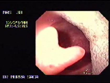 Bilobulated Uvula
