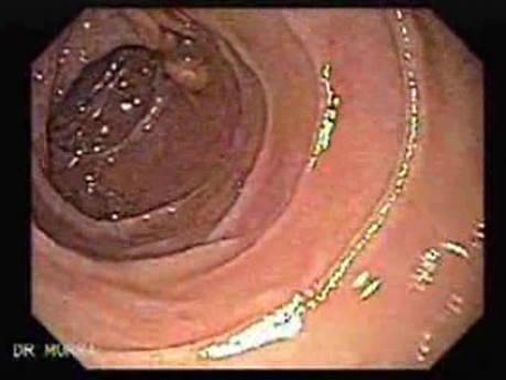 Duodenal Lymphangiectasia (1 of 5)