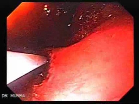 Severe Bleeding after Biopsies (4 of 7) - Absolute Alcohol Injection