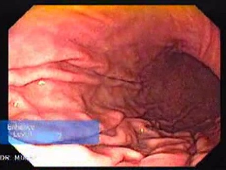High Resolution Video Endoscopy with Zoom - Different Levels of Zoom