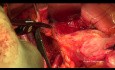 TMMR - Total Mesometrial Resection