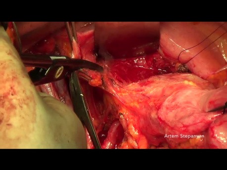 TMMR - Total Mesometrial Resection