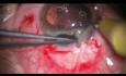 Posttraumatic Iris Plastic Surgery Without Need to Use Iris Implants