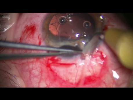 Posttraumatic Iris Plastic Surgery Without Need to Use Iris Implants