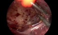 Laparoscopic Approach to Meckel’s Diverticulitis in a Scarred Abdomen : A Video Vignette