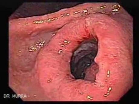 Gastric Cancer - Intestinal Metaplasia - Endoscopy (4 of 7)
