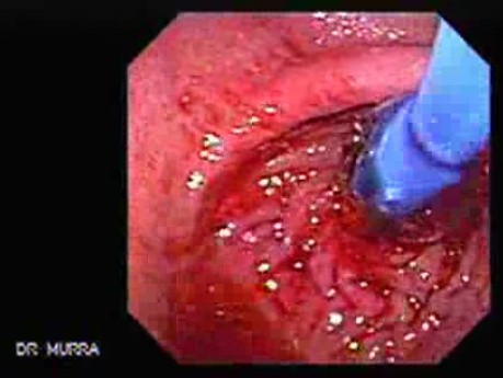 Esophageal Achalasia - Pneumatic Balloon Dilation, Video nr 1