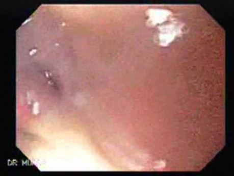 Post-irradiation Stenosis of the Esophagus - 77 Years-Old Female