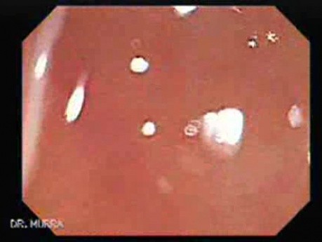 Schistosoma Mansoni in the Cecum (7 of 9)