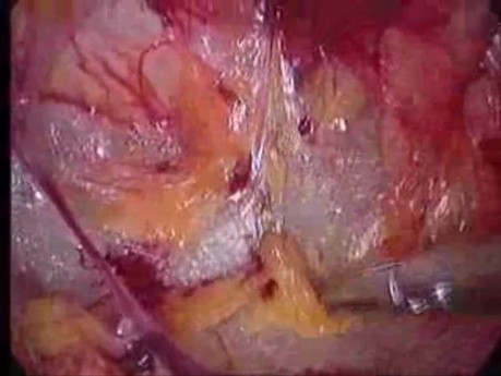 Total Extra Peritoneal (TEP) in 10 steps - Part 3