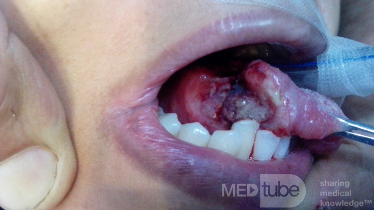 Tongue Cancer