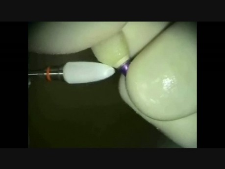 Implant Microsurgery: Immediate Implant and Provisional Mobile at 1 week!