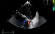 Prolapse Mitral Valve