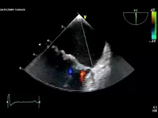 Prolapse Mitral Valve