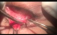 Treatment of Aberrant Eyelashes (Distichiasis)