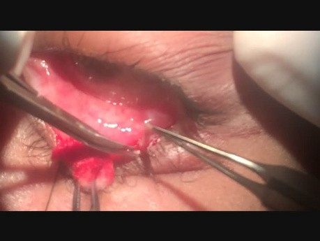 Treatment of Aberrant Eyelashes (Distichiasis)