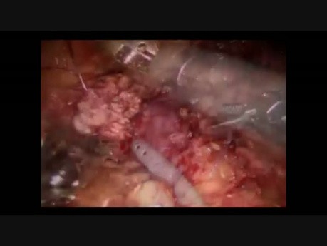 Distal Pancreatectomy Spleen Preserving