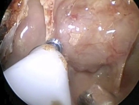 Transnasal Endoscopic Approach to the Pituitary Using an Ultrasonic Aspirator