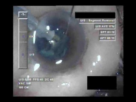 Swollen Conjunctiva - Part 3