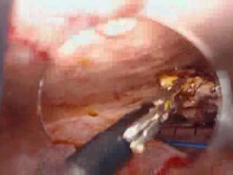 Colonic Perforation With Peritonitis - Laparoscopy (8 of 46)