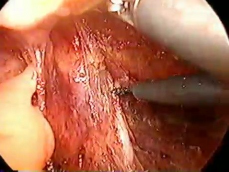 Laparoscopic abdominoperineal resection